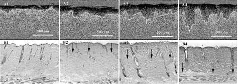 Improving the histologic characterization of burn depth